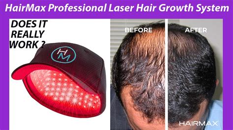 does hairmax really work
